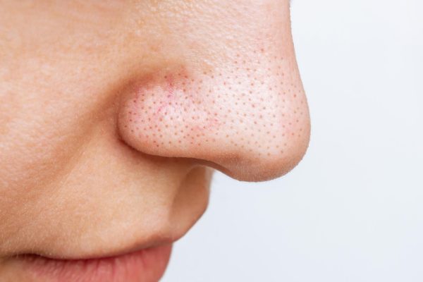 Open Pores